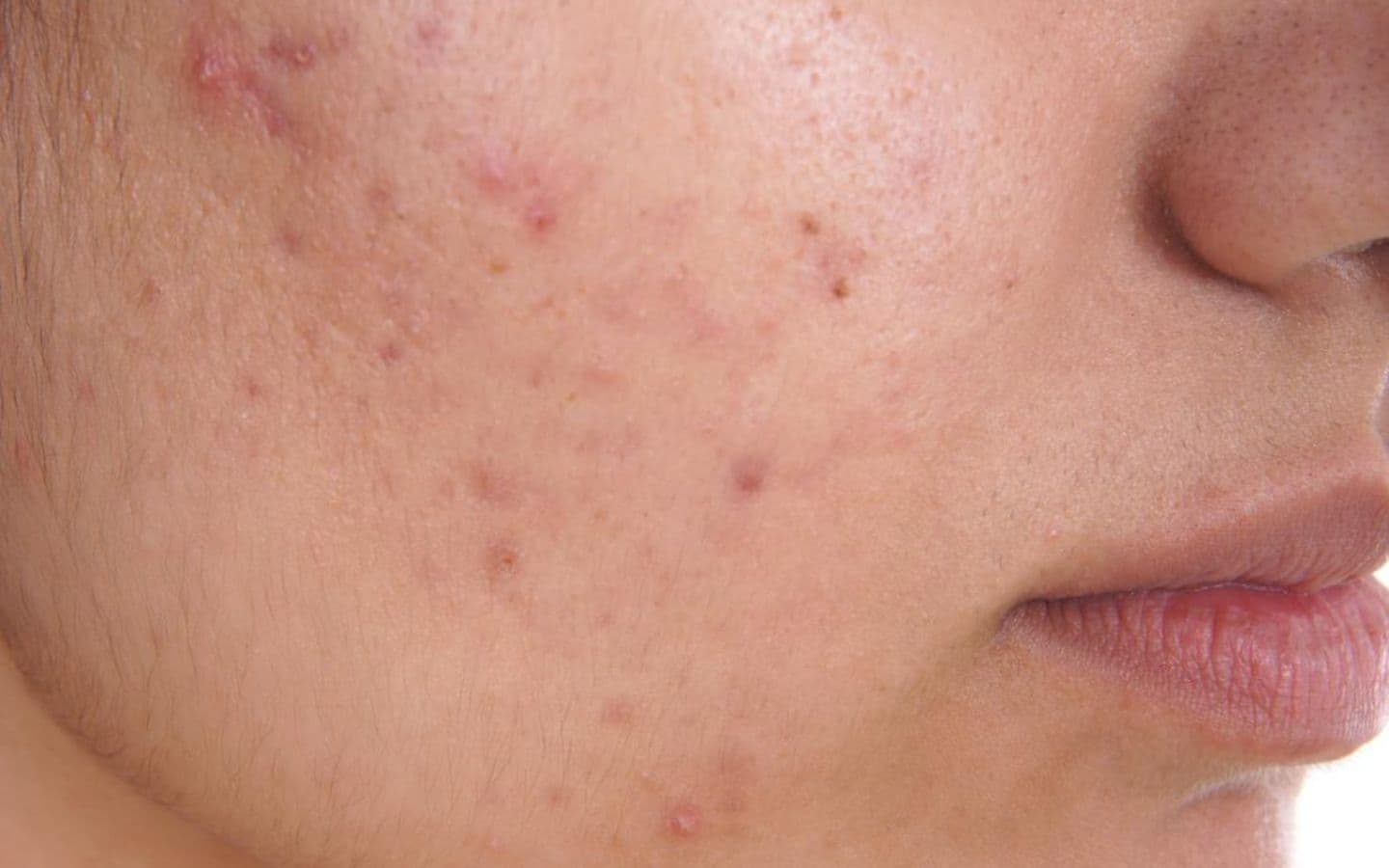 Acne, skin concern treated at Kaiteki Skin Aesthetic Clinic