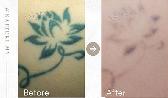 Tattoo removal laser - Discovery Pico Series - Quanta System - skin  rejuvenation / pigmented lesion treatment / scar removal