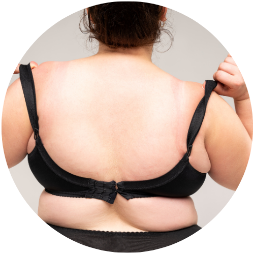 Bra Fat & Back Rolls