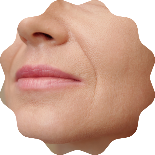 Nasolabial folds