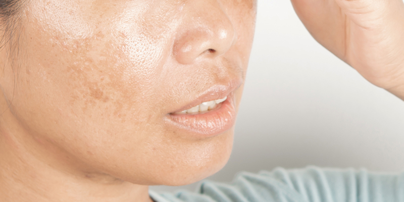 Loss of Collagen & Elastin