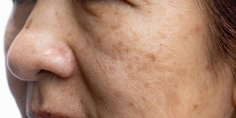 Sun-damaged skin and pigmentation clusters