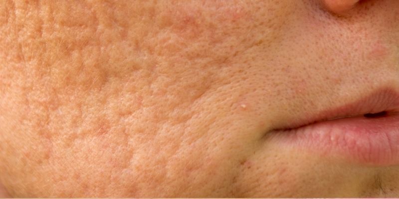 Post-acne scars that leave uneven texture